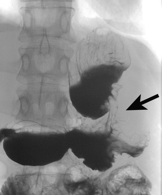 Figure 12: Contrast study showing a mid-gastric stricture (arrows).