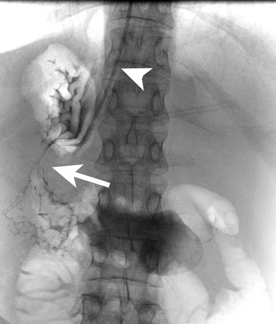 Figure 13 a: Insertion of a 24x100mm Egis double covered stent. Injection of air and contrast through the catheter (arrowhead) shows a tight stricture of the gastric body (arrow). 
