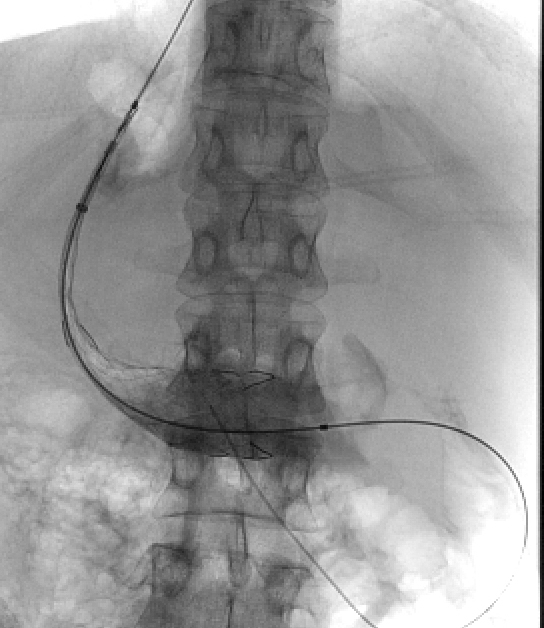 Figure 13 c: Part-deployed stent.