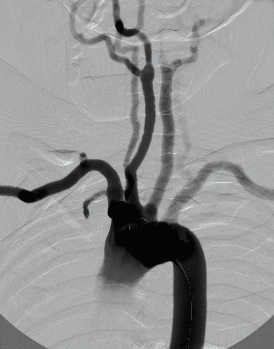 Carotid intervention module Carotid intervention module