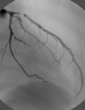Coronary module Coronary module
