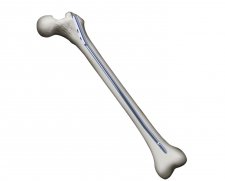 OrthoPediatrics PediNail Pediatric Femoral Nail | Used in Fracture fixation  | Which Medical Device