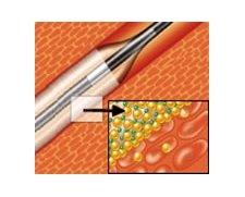 Medtronic IN.PACT Admiral Paclitaxel-eluting PTA Balloon | Used in Angioplasty, Fistuloplasty  | Which Medical Device