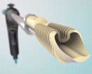Medshape Eclipse Soft Tissue Anchor | Used in Tendon repair | Which Medical Device