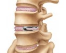NuVasive XL TDR | Used in Intervertebral disc replacement | Which Medical Device