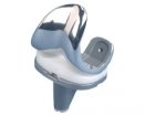 Zimmer NexGen Knee Replacement System | Used in Knee replacement | Which Medical Device