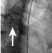 Figure 16c: Delivery system in position (level of fistula indicated by paper clip on patient?s skin).