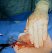 Both Part 1 and Part 2 are now withdrawn from the artery while maintaining digital pressure on the puncture site. This leaves the bar inside the arterial wall, the collagen plug loosely outside, and the blue tamping tube outside the patient on the thread. 