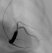 Contrast injection to the coronary sinus at RAO 30�. Deflation of the balloon catheter may reveal additional coronary sinus side branches that were blocked by the balloon during the contrast injection.