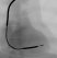 RV lead placement: Right Ventricle lead placement procedure. The displayed electrode lead is an extendable/retractable defibrillation electrode.