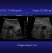 zonare-zone-cysts.jpg