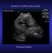 zonare-zone-neonatal-kidney2.jpg