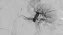 Embolisation of renal artery pseudoaneurysm post partial nephrectomy