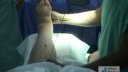 Cobb procedure for acquired flatfoot deformity