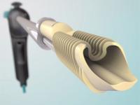Eclipse Soft Tissue Anchor: image from Medscape