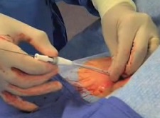 Femoral Introducer Sheath and Hemostasis device - video image from Morris Innovative (approval pending)