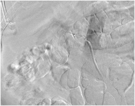 Fig 5 OneShot balloon inflation causing occlusion of the renal artery as demonstrated by absence of contrast beyond the balloon. This confirms electrode apposition with the renal artery wall.