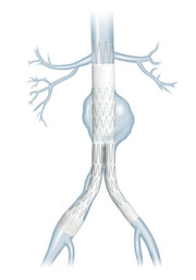 Cook Zenith Flex AAA Endovascular Graft