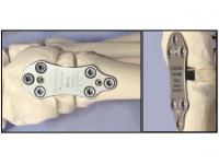 Osteowedge - image from GraMedica