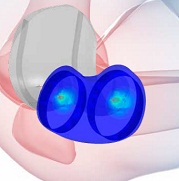 Contact Mechanics: Evaluate tibiofemoral contact mechanics at static positions throughout flexion using the Contact Mechanics workflow in the Abaqus Knee Simulator.