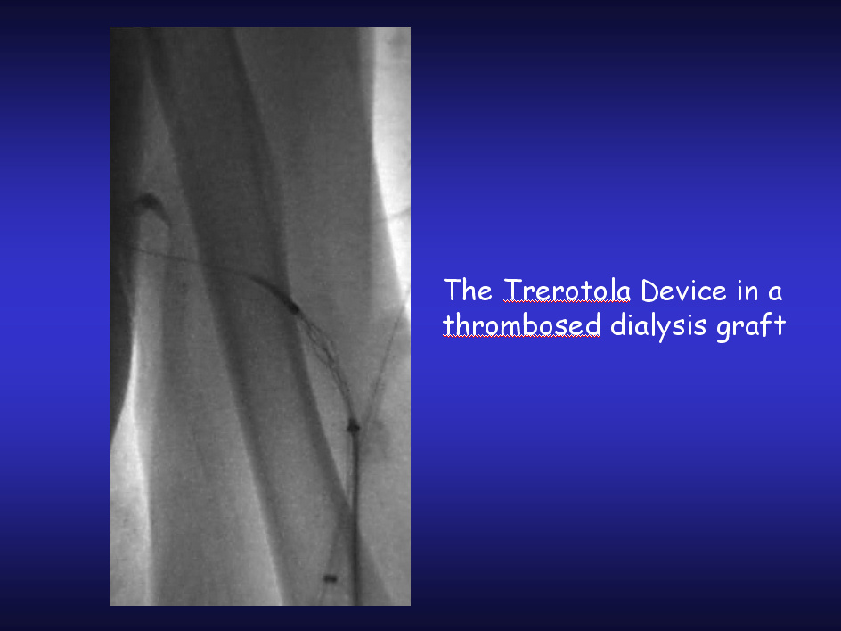 Device in throbosed dialysis graft