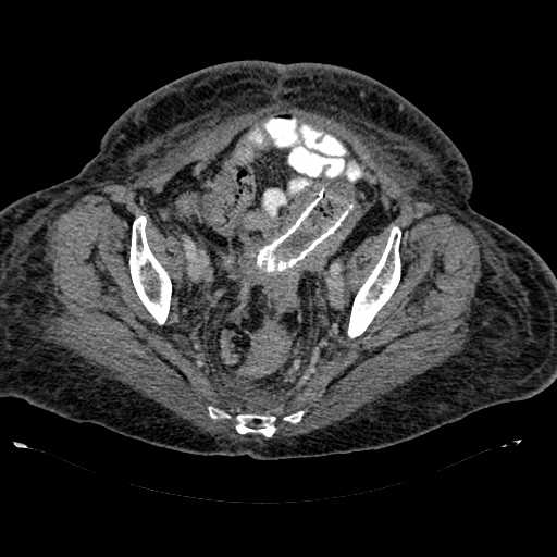 Figure 10 Re-staging CT showing complete stent expansion.