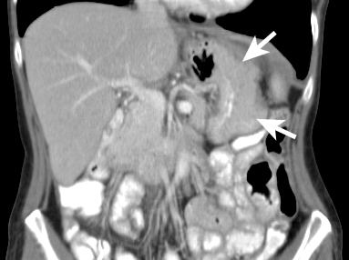 Figure 11: Gastric stent - Axial and coronal CT images demonstrating eccentric tumour infiltration of the greater curve of the stomach (arrows).