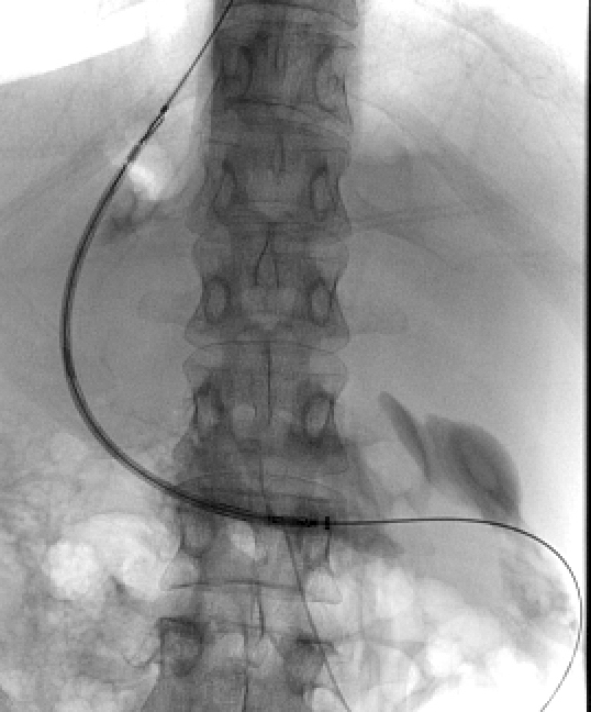 Figure 13 b: Insertion of the delivery system over a stiff guide wire placed in the duodenum.