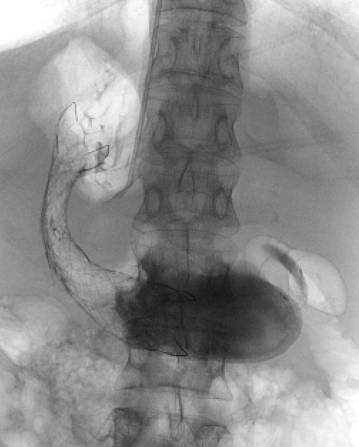 Figure 13 d: Fully deployed stent.