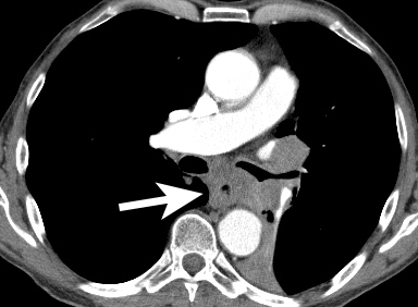 Figure 14: Tracheo-oesophageal fistula - Axial CT showing a thickened oesophagus due to invasion from the adjacent lung cancer.