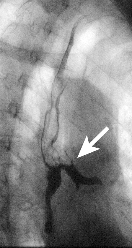 Figure 15: Iohexol swallow shows a large fistula into the left main bronchus (arrow).