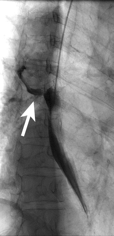 Figure 16a: Tracheo-oesophageal fistula outlined by contrast injection through a per-nasal catheter (patient prone).