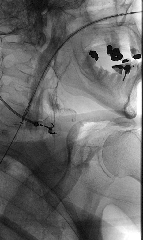 Figure 16b: Insertion of the 10Fr. introducer system through the nose.