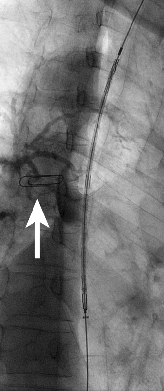 Figure 16c: Delivery system in position (level of fistula indicated by paper clip on patient?s skin).