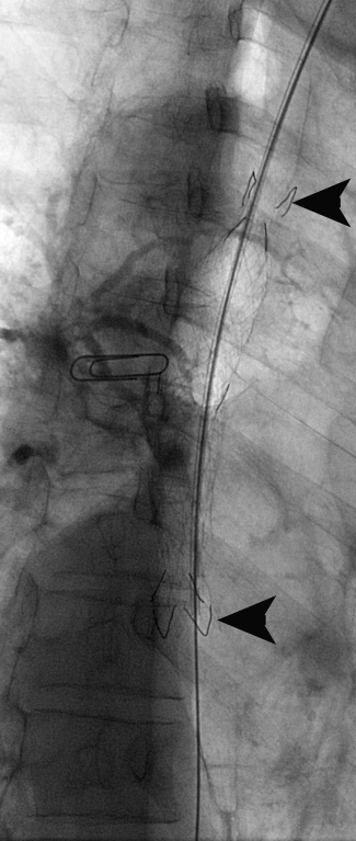 Figure 16d: Deployed stent (arrowheads) with immediate full expansion.