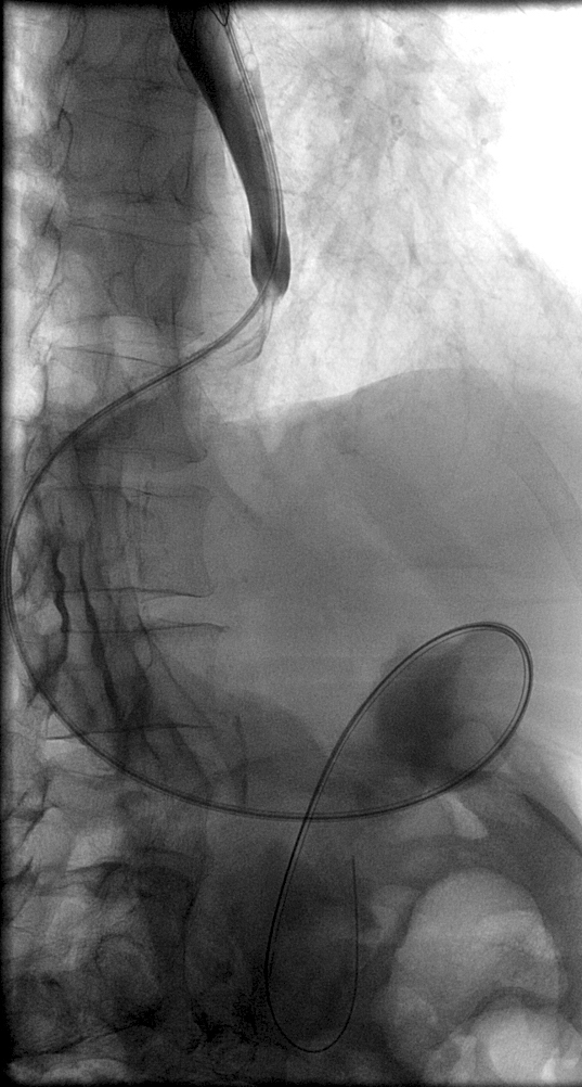 Figure 16e: Nasal feeding tube inserted into the duodenum using the existing wire.