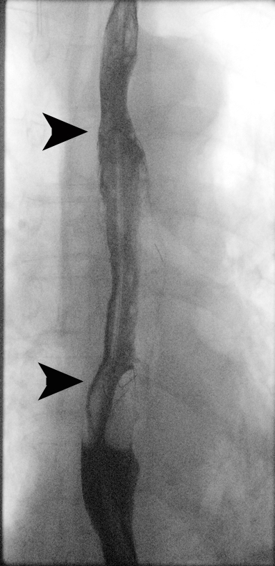 Figure 17: Contrast swallow shows sealing of the fistula, the stent markers (arrowheads) are obscured by contrast.