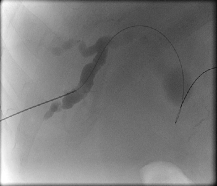 Figure 4a: Biliary stent - right duct PTC showing extensive occlusion of the common duct.