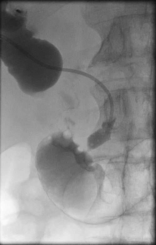 Figure 4a: Biliary stent - right duct PTC showing extensive occlusion of the common duct.