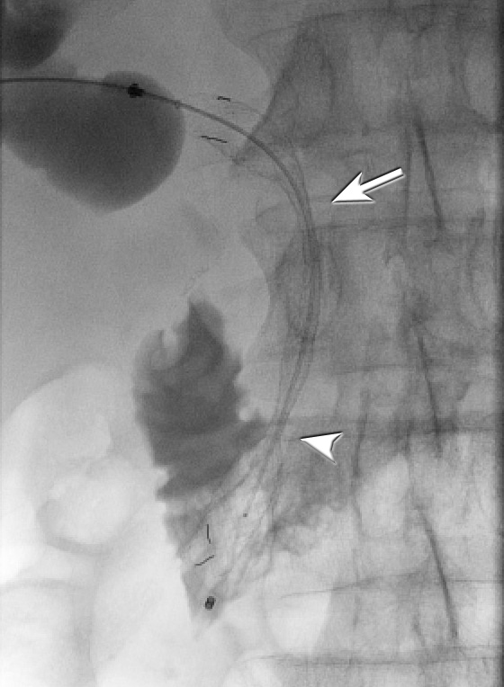 Figure 5a: Immediate stent approximately 25% across the stricture (arrow) with further constraint visible across the sphincter of Oddi (arrowhead).  There was limited drainage of contrast. 