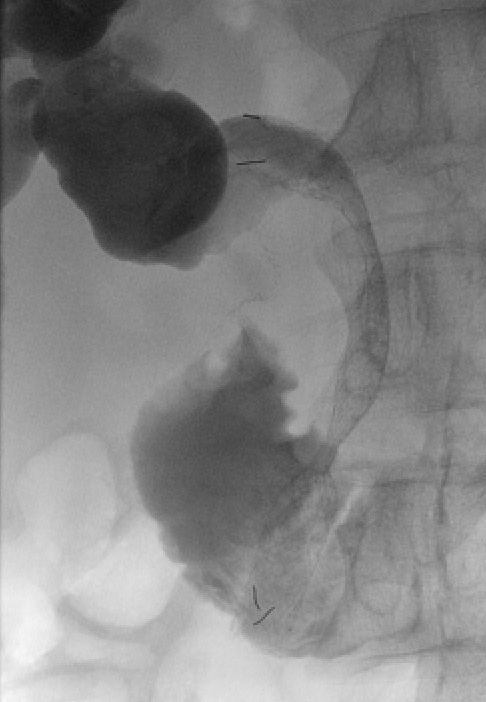Figure 5b: Note the blind ending upper duodenum of the B2 gastrectomy.