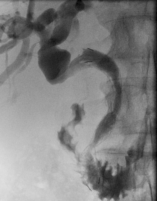Figure 6a Check cholangiogram shows spontaneous further stent expansion with good flow into the duodenum.