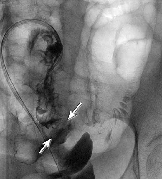 Figure 7 Colonic stent: Tight mid-sigmoid stricture reached by using a biliary manipulation catheter as well as a renal sheath.