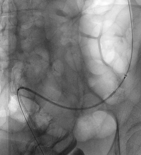 Figure 8a: Stent deployment over a super-stiff wire. 