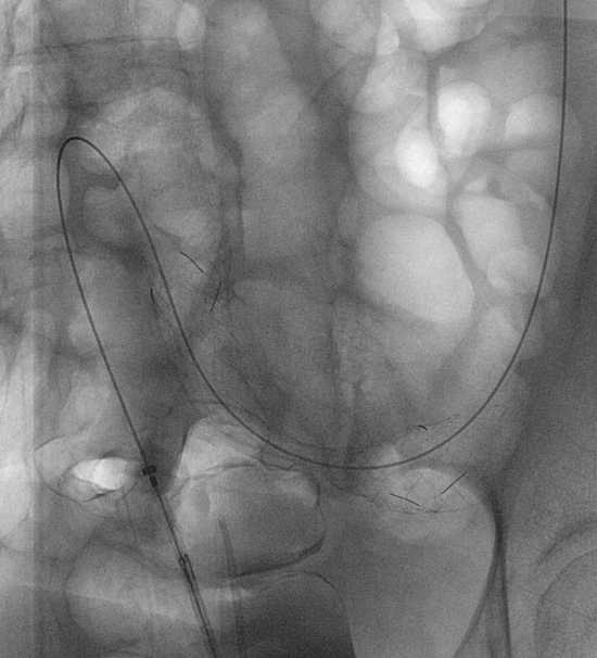 Figure 8b: The proximal end was lying in the apex of a flexure. Due to the difficult access it was decided to extend this to optimise alignment with the axis of the bowel.