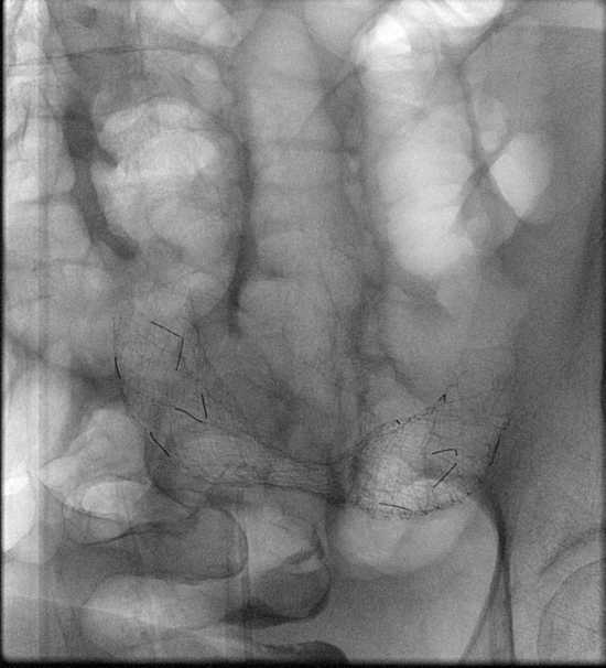 Figure 9: Stent deployed.