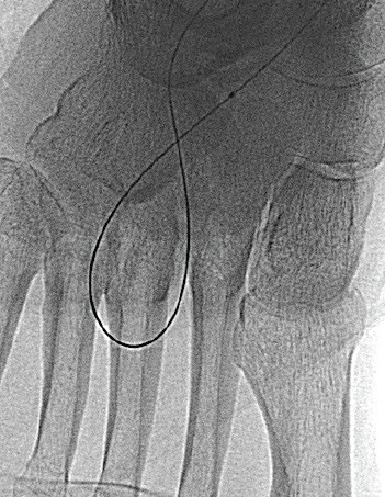 This image demonstrates the low profile and flexibility of the Bantam Alpha angioplasty balloon.