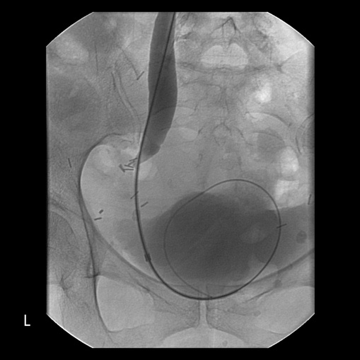 A left tight distal ureteric stricture caused by reccurent cervical cancer.