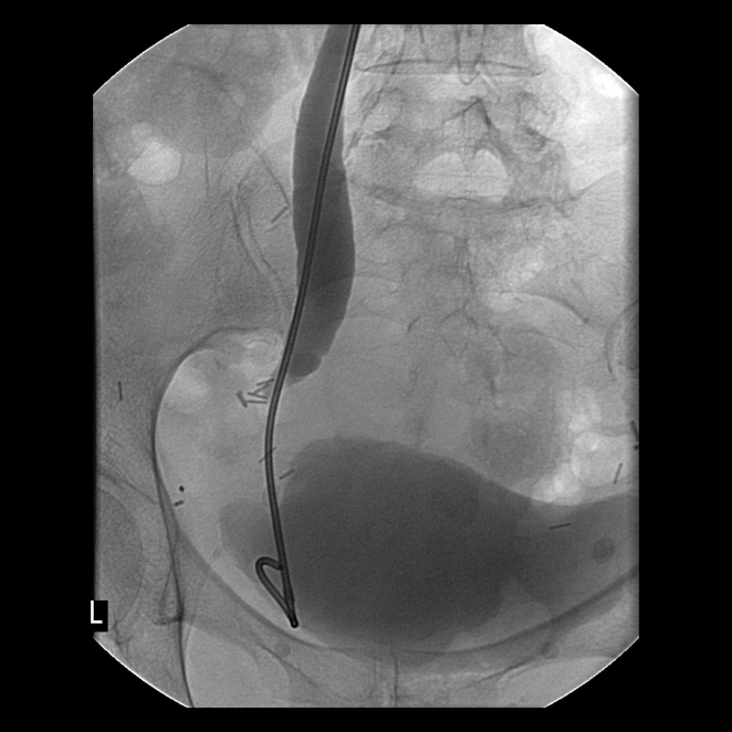 Stent deployment in the bladder