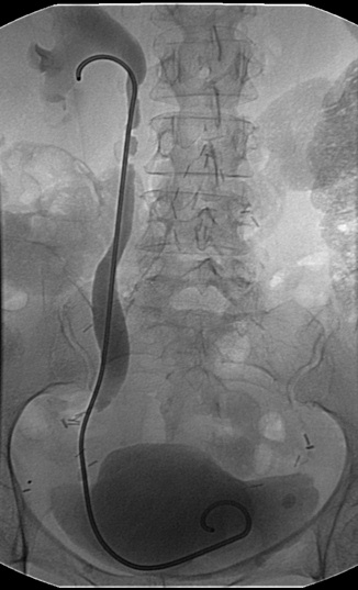The proximal end deployed